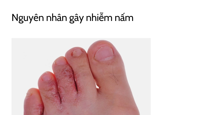 Biện pháp chăm sóc da chân ngừa nấm tái phát